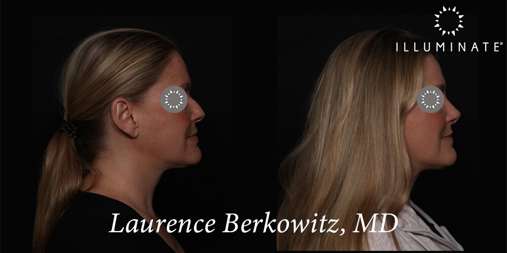 Rhinoplasty Before & After Image