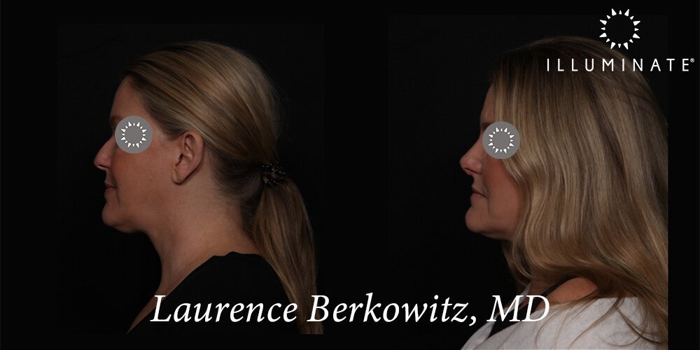 Rhinoplasty Before & After Image