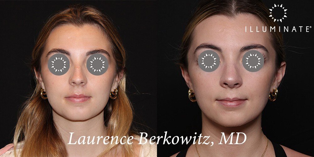 Rhinoplasty Before & After Image
