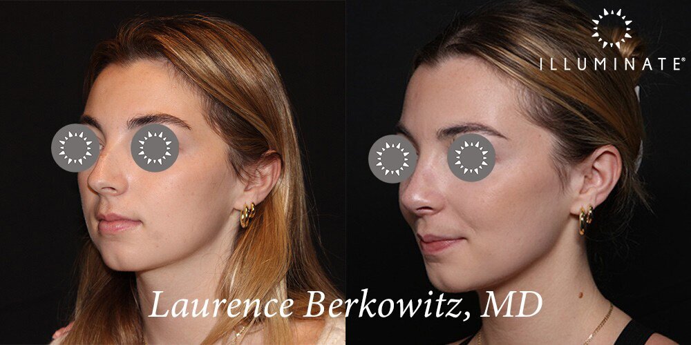Rhinoplasty Before & After Image