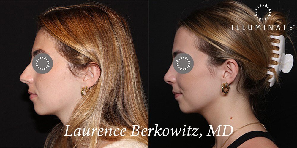 Rhinoplasty Before & After Image