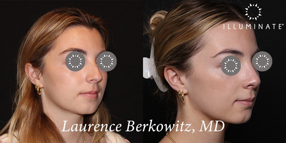 Rhinoplasty Before & After Image