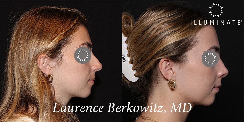 Rhinoplasty Before & After Image