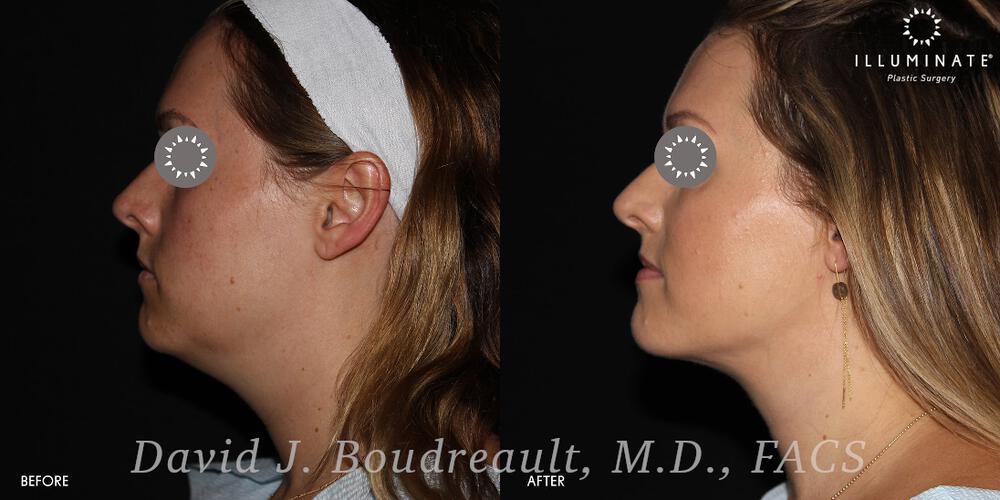 Submental Liposuction Before & After Image