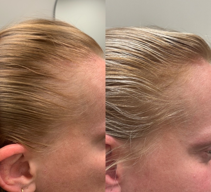 Alma TED Before & After Image