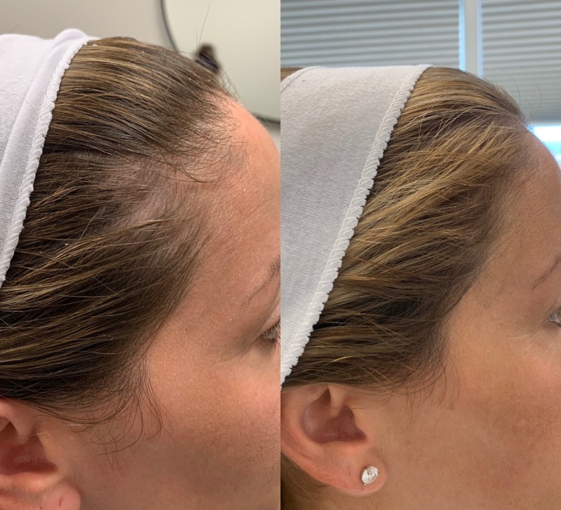 Alma TED Before & After Image