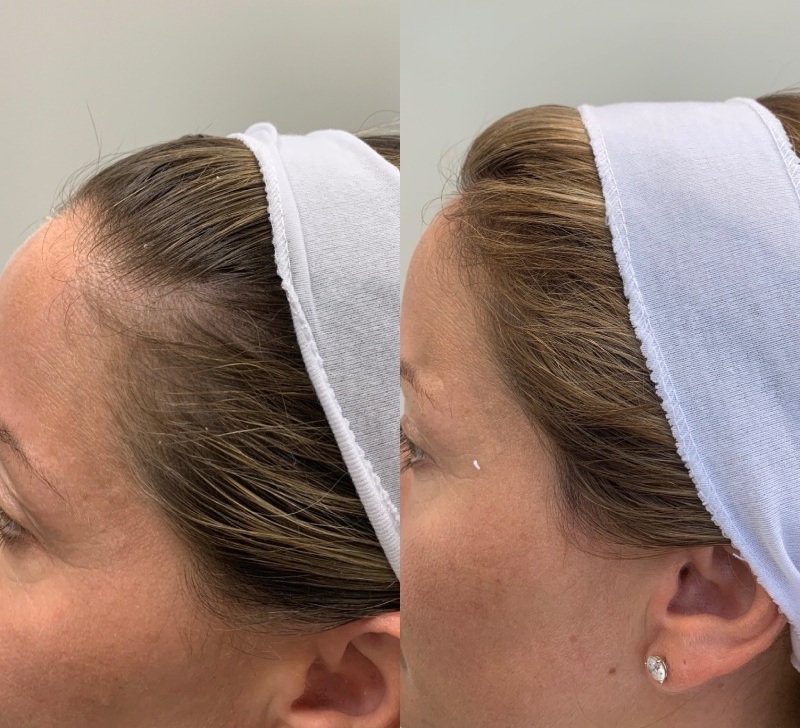 Alma TED Before & After Image