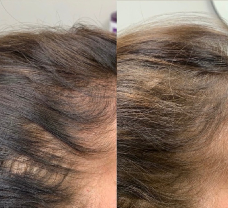 Alma TED Before & After Image