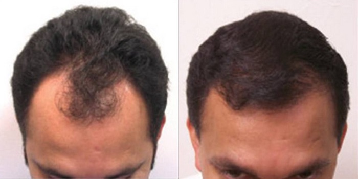 NeoGraft Before & After Image